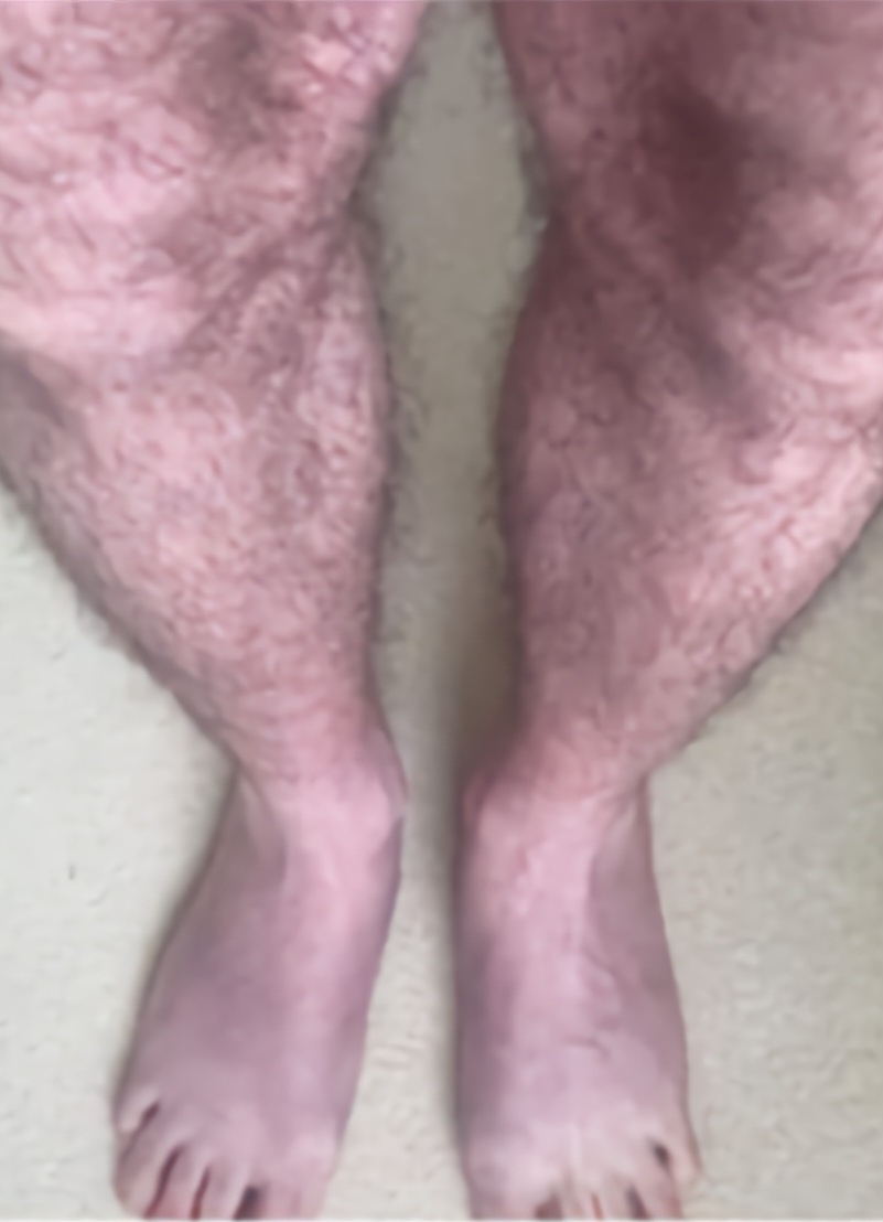 영국에서 10분 이상 서 있으면 다리가 푸른빛을 띠게 되는 ‘푸른 다리 증후군(blue legs symptom)’이 새로운 코로나19 장기 후유증으로 보고됐다. (사진= 마노 시반 박사 제공)